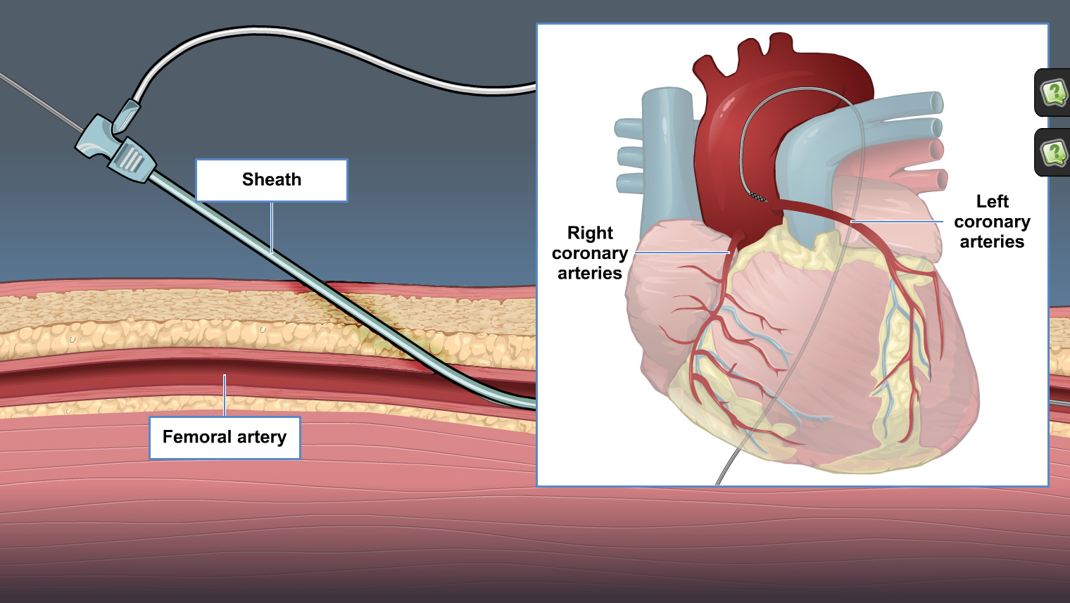 cardiovascular catheters
