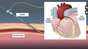 The Principles of Cardiac Catheterization