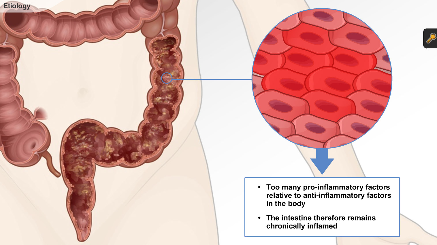 Understanding Ulcerative Colitis Adam Ondemand 3261