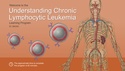 Understanding Chronic Lymphocytic Leukemia